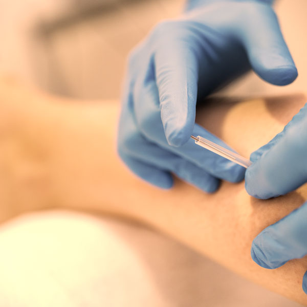 Dry needling